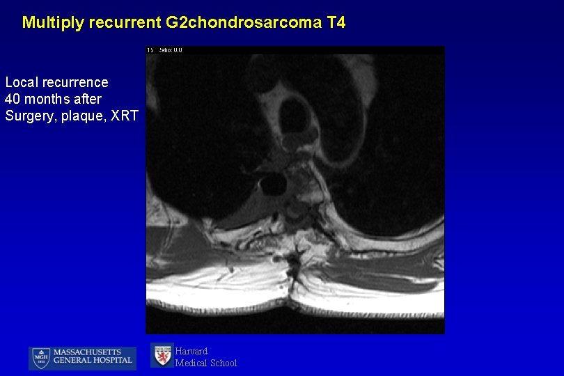 Multiply recurrent G 2 chondrosarcoma T 4 Local recurrence 40 months after Surgery, plaque,