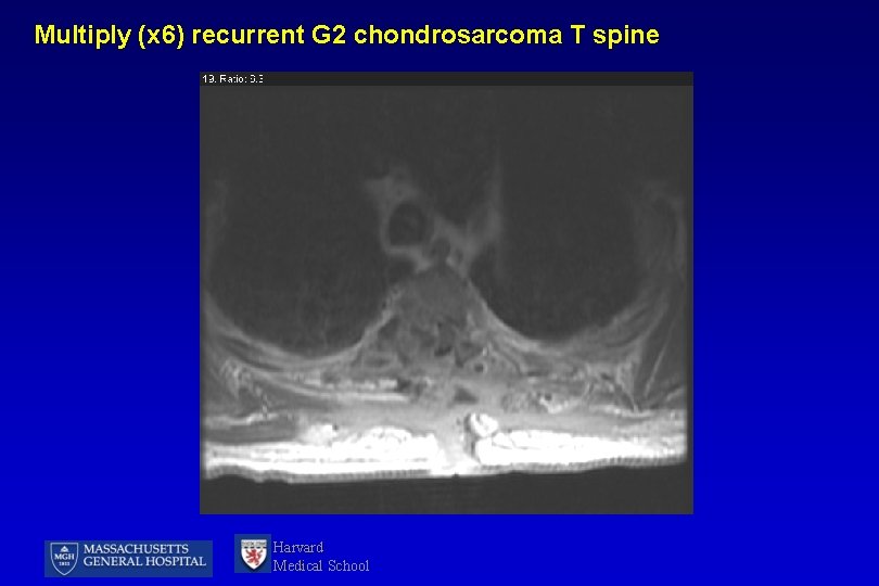 Multiply (x 6) recurrent G 2 chondrosarcoma T spine Harvard Medical School 