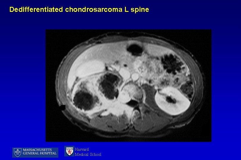 Dedifferentiated chondrosarcoma L spine Harvard Medical School 