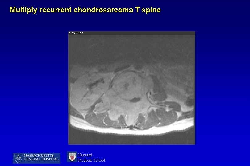 Multiply recurrent chondrosarcoma T spine Harvard Medical School 