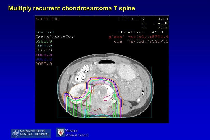 Multiply recurrent chondrosarcoma T spine Harvard Medical School 