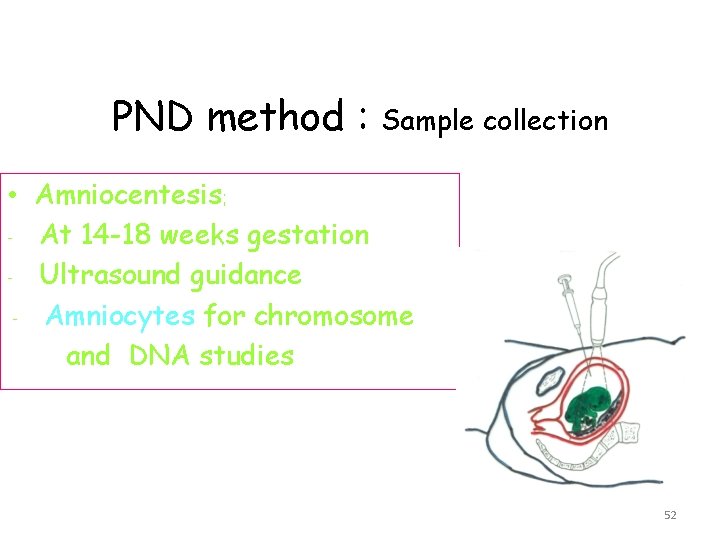 PND method : Sample collection • - Amniocentesis; At 14 -18 weeks gestation Ultrasound