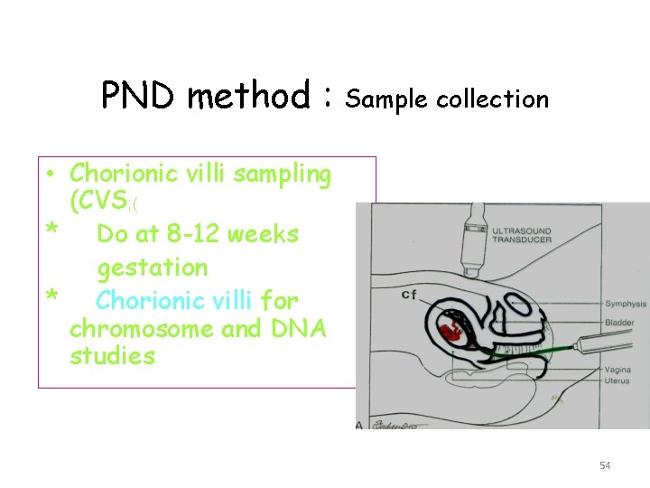 PND method : Sample collection • Chorionic villi sampling (CVS; ( * Do at