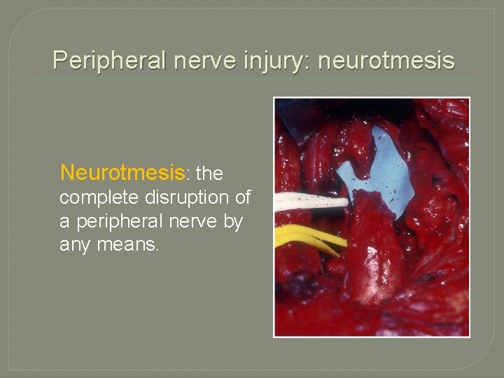 Peripheral nerve injury: neurotmesis Neurotmesis: the complete disruption of a peripheral nerve by any Peripheral nerve injury: neurotmesis Neurotmesis: the complete disruption of a peripheral nerve by any