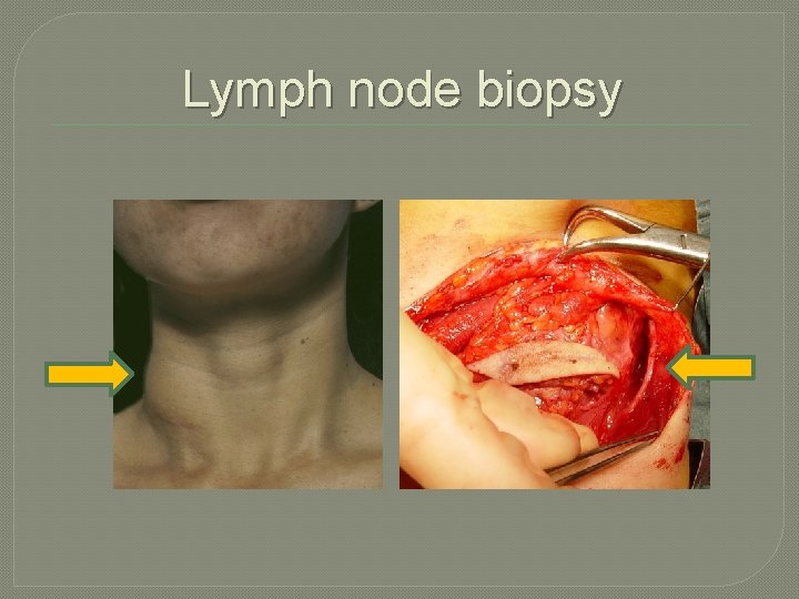 Lymph node biopsy Lymph node biopsy