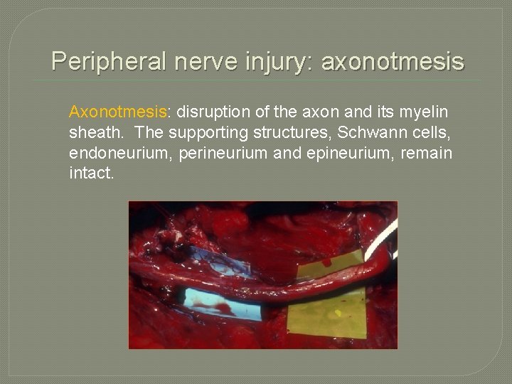 Peripheral nerve injury: axonotmesis Axonotmesis: disruption of the axon and its myelin sheath. The Peripheral nerve injury: axonotmesis Axonotmesis: disruption of the axon and its myelin sheath. The