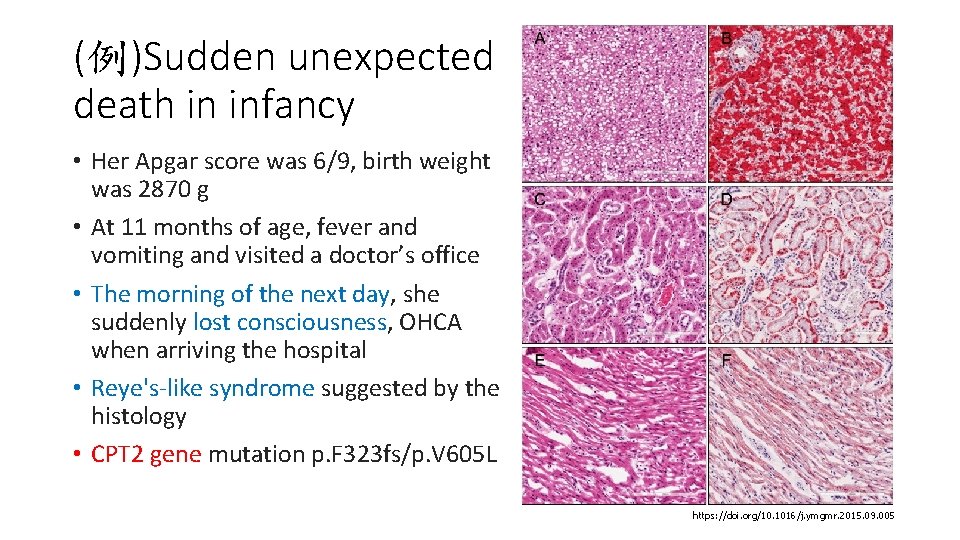 (例)Sudden unexpected death in infancy • Her Apgar score was 6/9, birth weight was