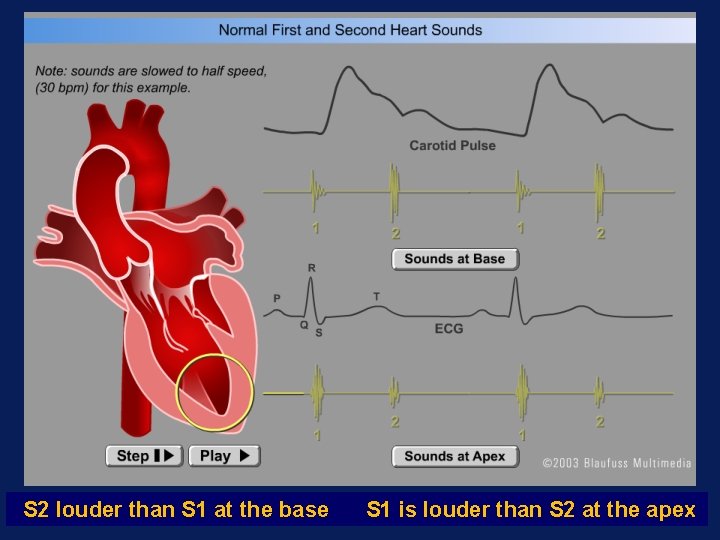 S 2 louder than S 1 at the base S 1 is louder than