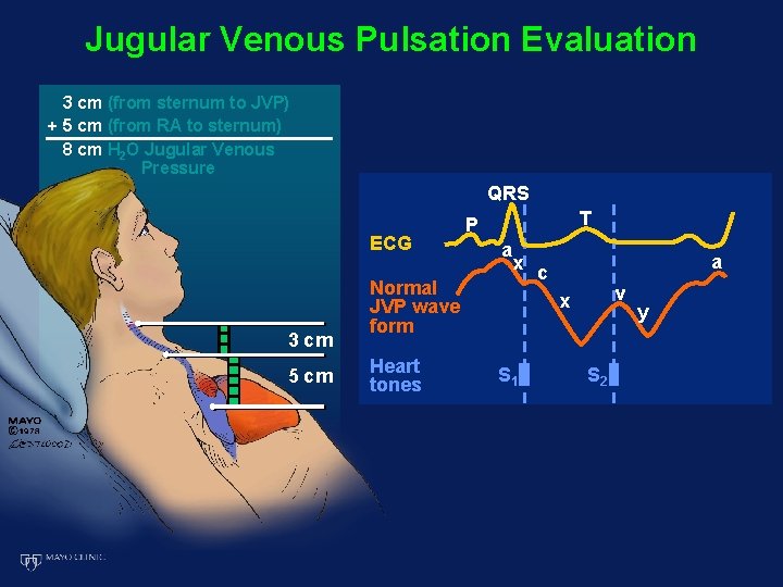 Jugular Venous Pulsation Evaluation 3 cm (from sternum to JVP) + 5 cm (from