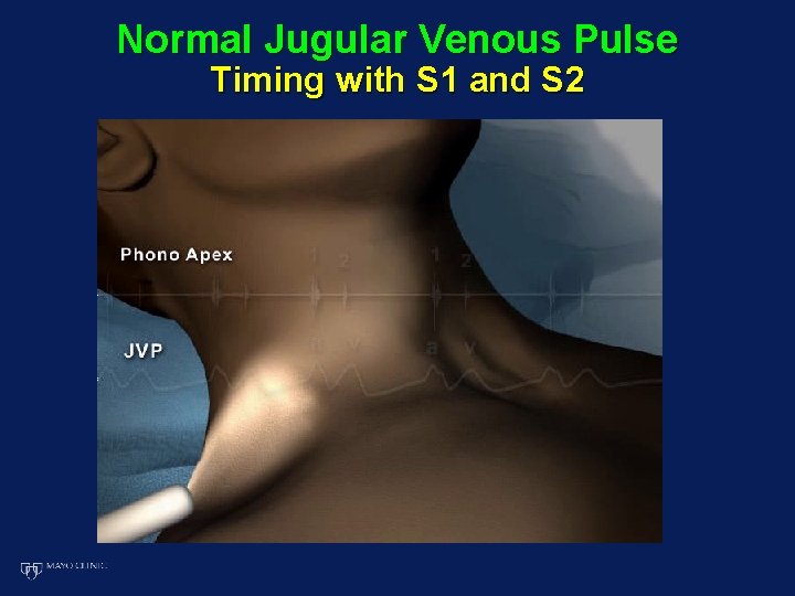 Normal Jugular Venous Pulse Timing with S 1 and S 2 