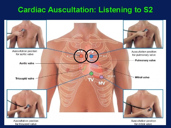 Cardiac Auscultation: Listening to S 2 AV PV L 2 nd ICS R 2