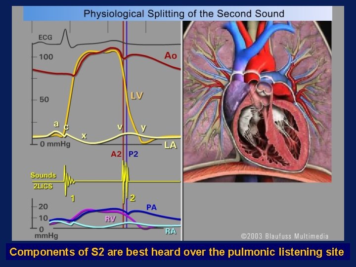 Components of S 2 are best heard over the pulmonic listening site 