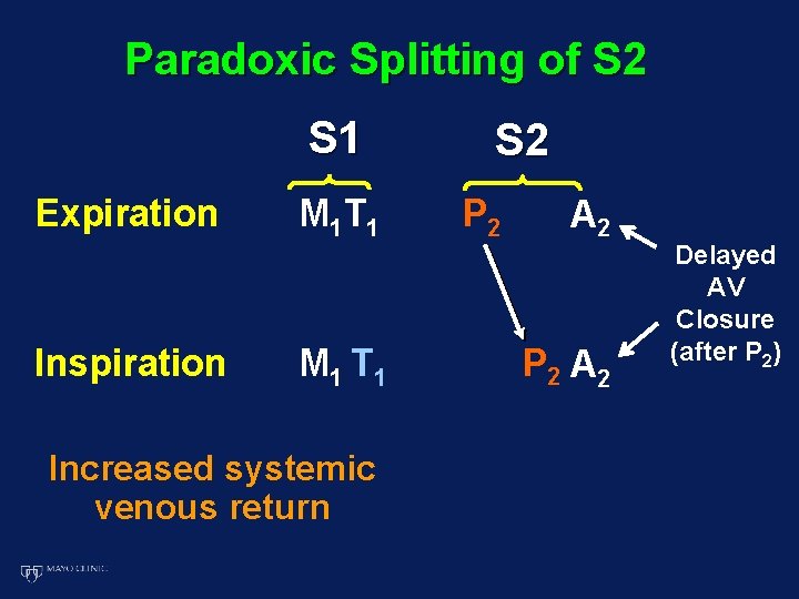 Paradoxic Splitting of S 2 S 1 Expiration Inspiration M 1 T 1 Increased