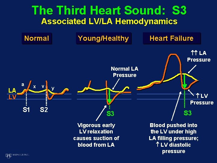 The Third Heart Sound: S 3 Associated LV/LA Hemodynamics Young/Healthy Normal Heart Failure LA