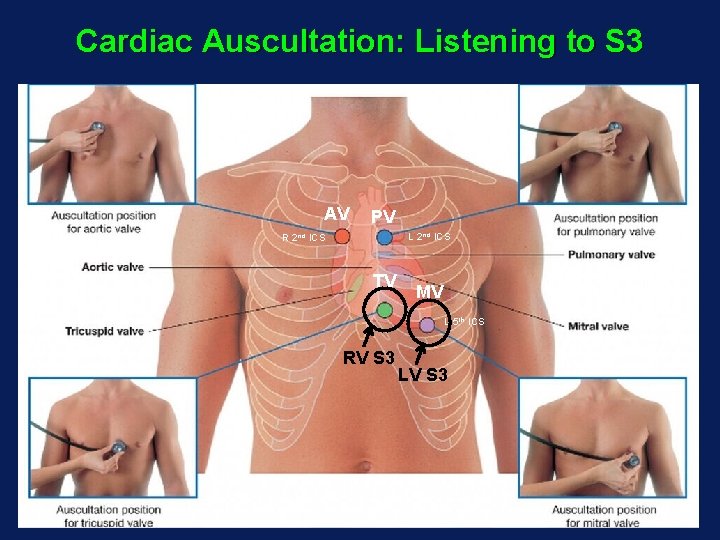 Cardiac Auscultation: Listening to S 3 AV PV L 2 nd ICS R 2