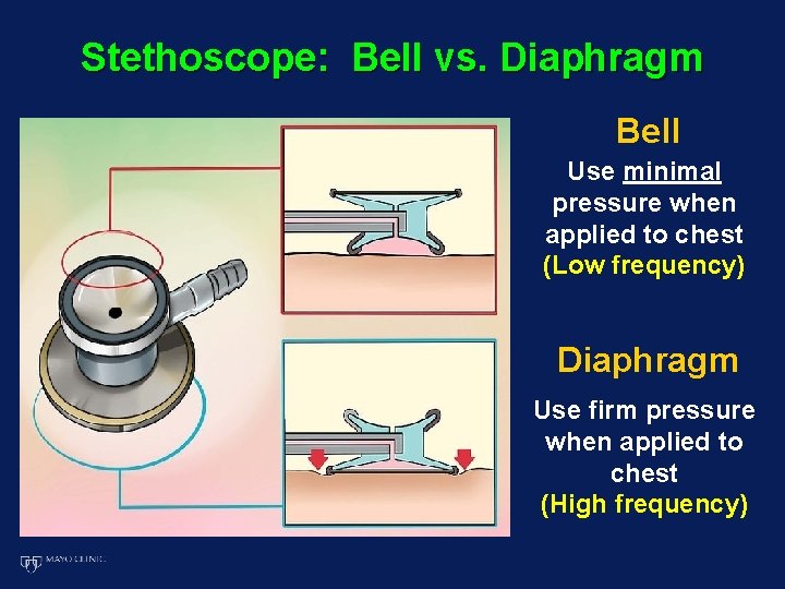 Stethoscope: Bell vs. Diaphragm Bell Use minimal pressure when applied to chest (Low frequency)