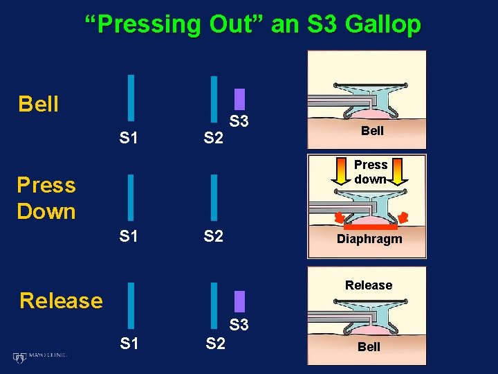 “Pressing Out” an S 3 Gallop Bell S 1 S 2 S 3 Bell