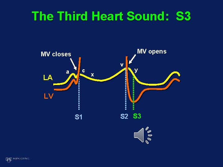 The Third Heart Sound: S 3 MV opens MV closes LA a c v