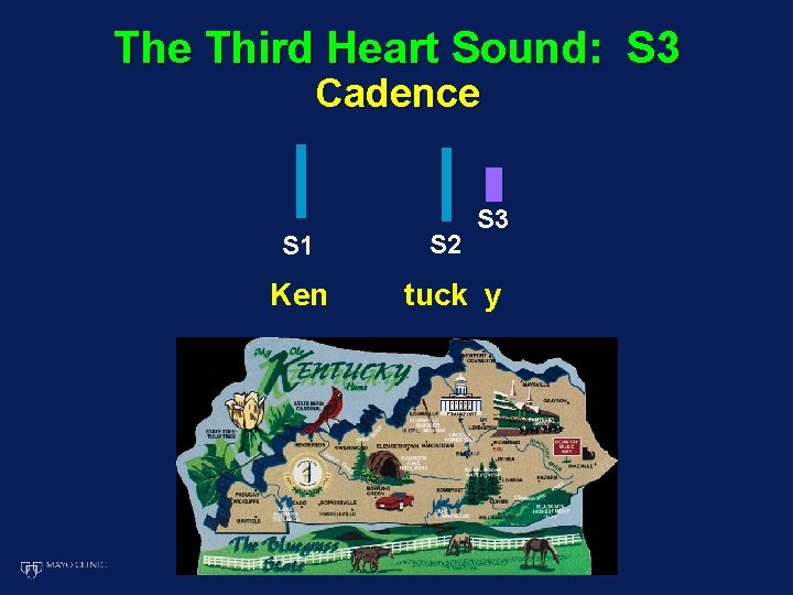 The Third Heart Sound: S 3 Cadence S 3 S 1 S 2 Ken