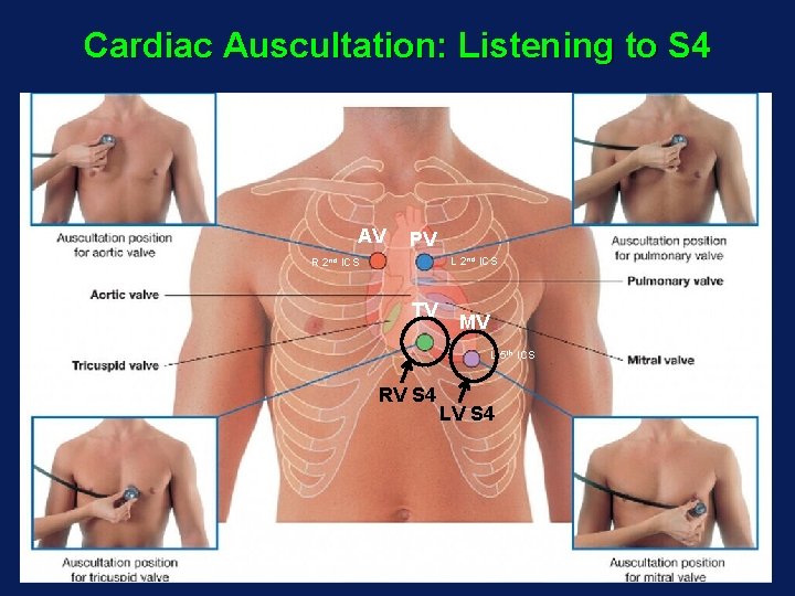 Cardiac Auscultation: Listening to S 4 AV PV L 2 nd ICS R 2