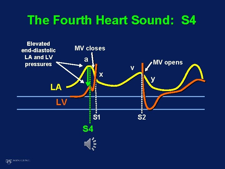 The Fourth Heart Sound: S 4 Elevated end-diastolic LA and LV pressures MV closes