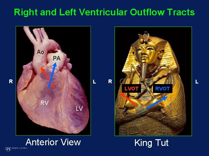 Right and Left Ventricular Outflow Tracts Ao PA R L LVOT RV RVOT LV