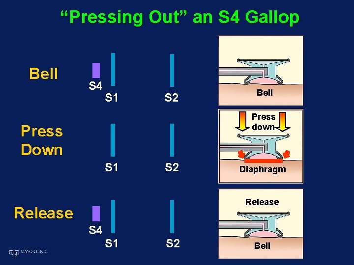 “Pressing Out” an S 4 Gallop Bell S 4 S 1 S 2 Bell