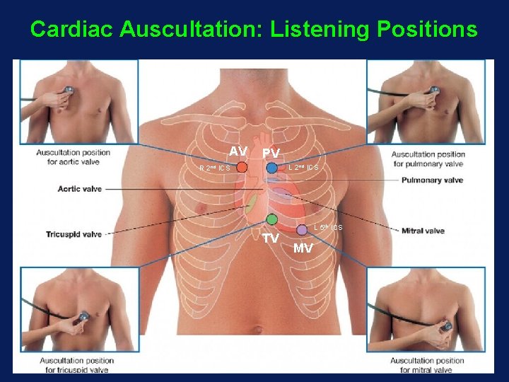 Cardiac Auscultation: Listening Positions AV PV L 2 nd ICS R 2 nd ICS