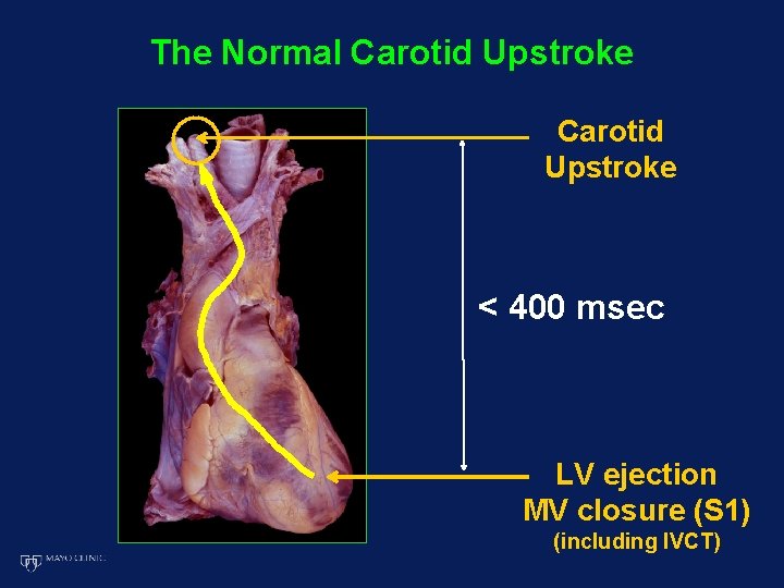 The Normal Carotid Upstroke < 400 msec LV ejection MV closure (S 1) (including