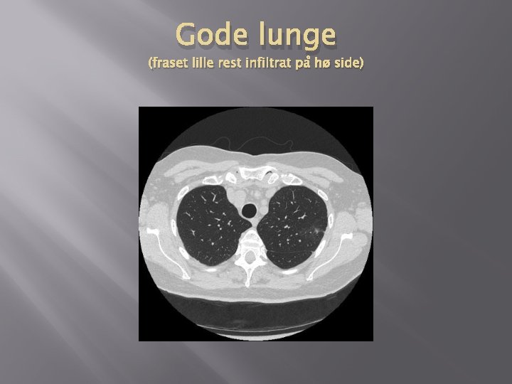 Gode lunge (fraset lille rest infiltrat på hø side) Gode lunge (fraset lille rest infiltrat på hø side)