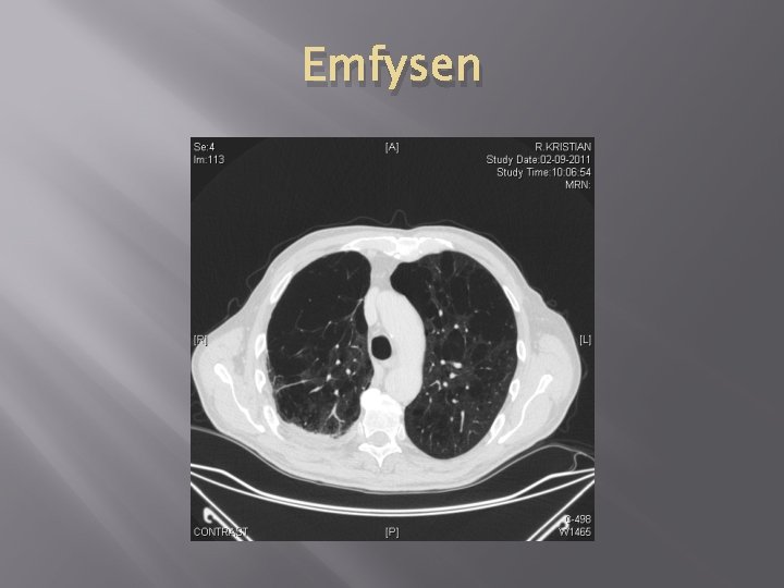 Emfysen Emfysen
