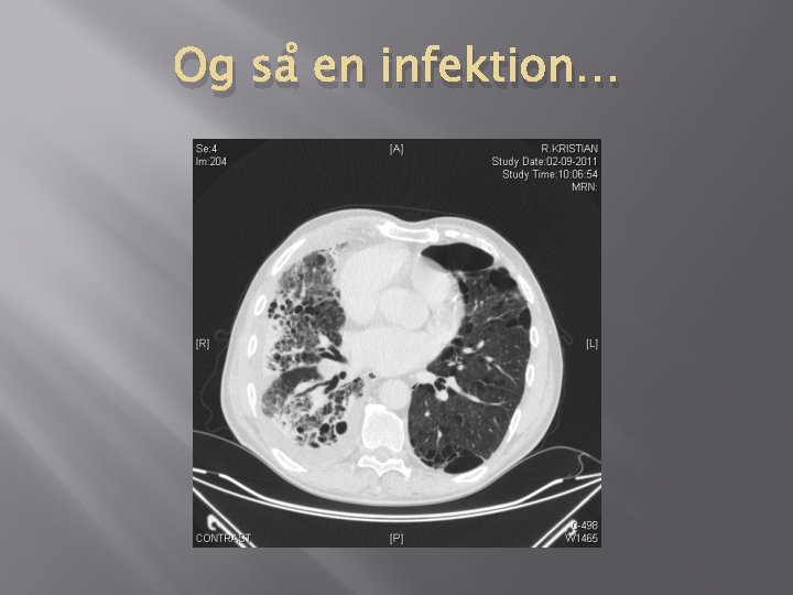 Og så en infektion… Og så en infektion…