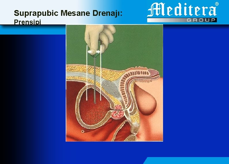 Suprapubic Mesane Drenajı: Prensipi 