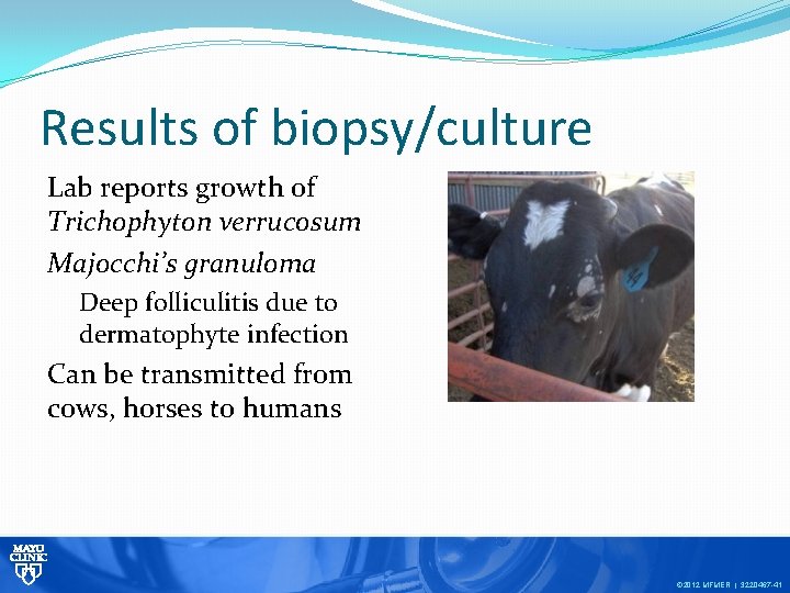 Results of biopsy/culture Lab reports growth of Trichophyton verrucosum Majocchi’s granuloma Deep folliculitis due