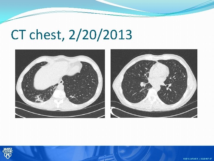 CT chest, 2/20/2013 © 2012 MFMER | 3220467 -47 