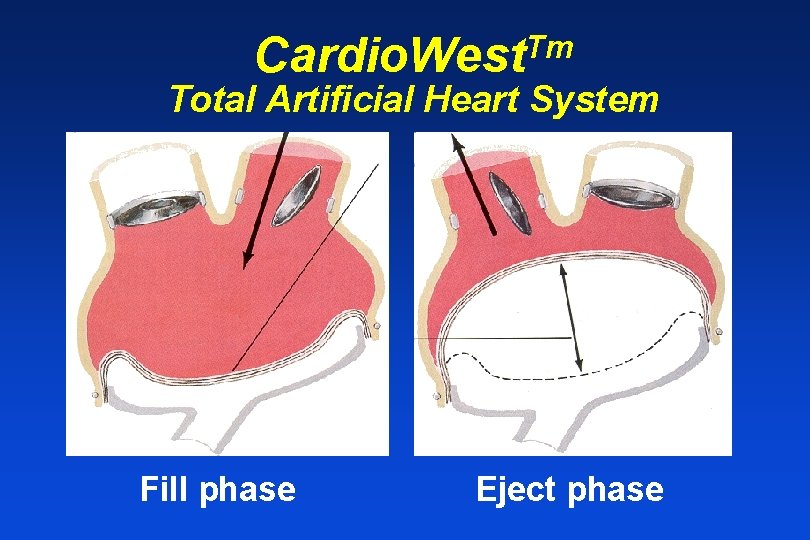 Tm Cardio. West Total Artificial Heart System Fill phase Eject phase 