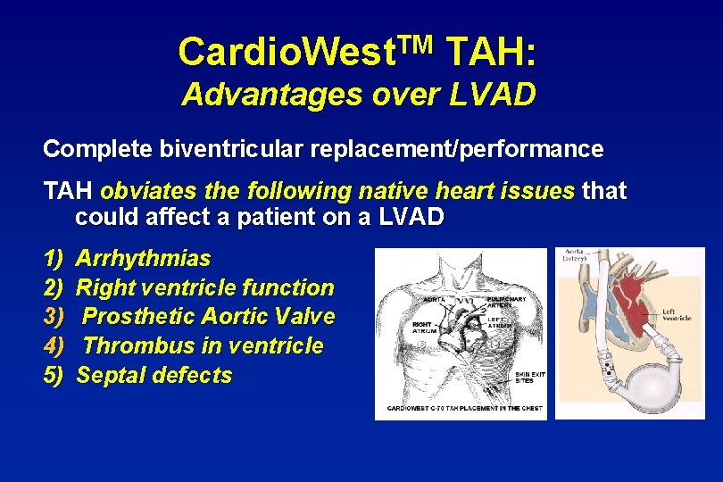 TM Cardio. West TAH: Advantages over LVAD Complete biventricular replacement/performance TAH obviates the following