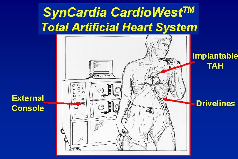Syn. Cardia TM Cardio. West Total Artificial Heart System Implantable TAH External Console Drivelines