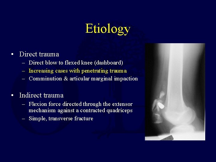 Etiology • Direct trauma – Direct blow to flexed knee (dashboard) – Increasing cases