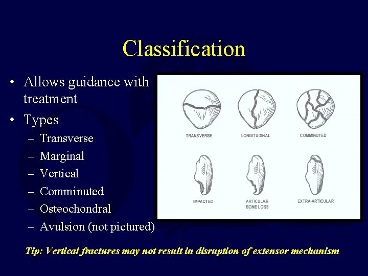 Classification • Allows guidance with treatment • Types – – – Transverse Marginal Vertical