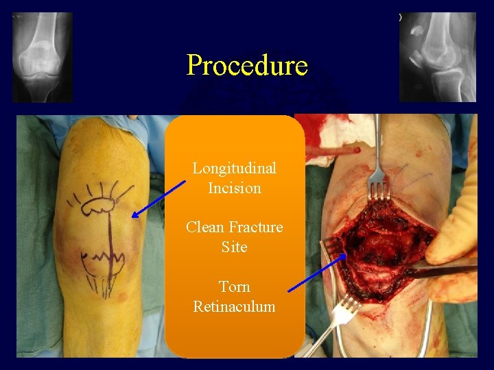 Procedure Longitudinal Incision Clean Fracture Site Torn Retinaculum 