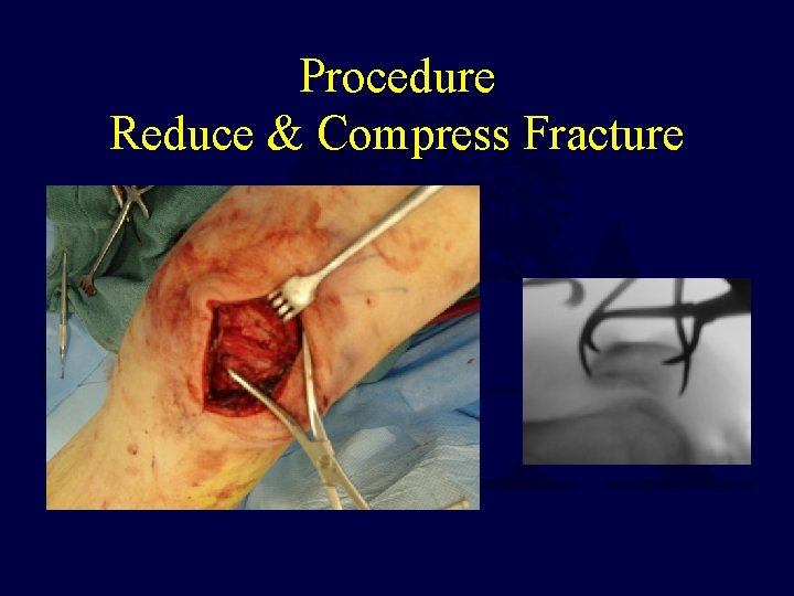 Procedure Reduce & Compress Fracture 