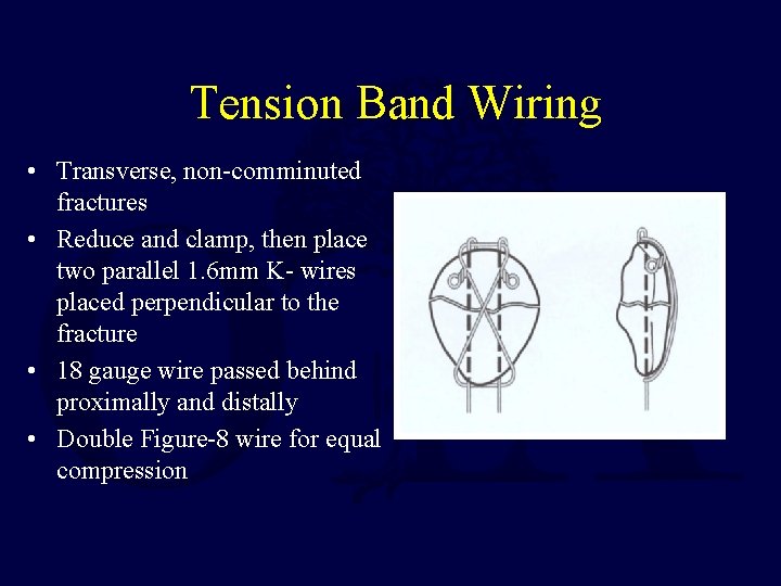 Tension Band Wiring • Transverse, non-comminuted fractures • Reduce and clamp, then place two