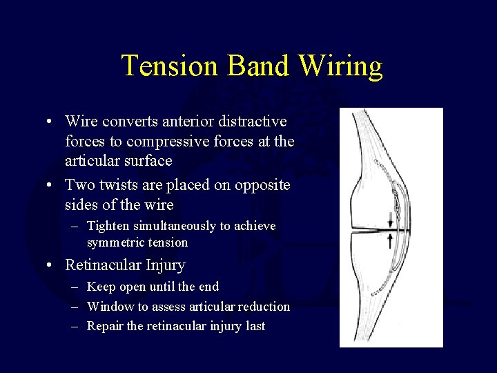 Tension Band Wiring • Wire converts anterior distractive forces to compressive forces at the