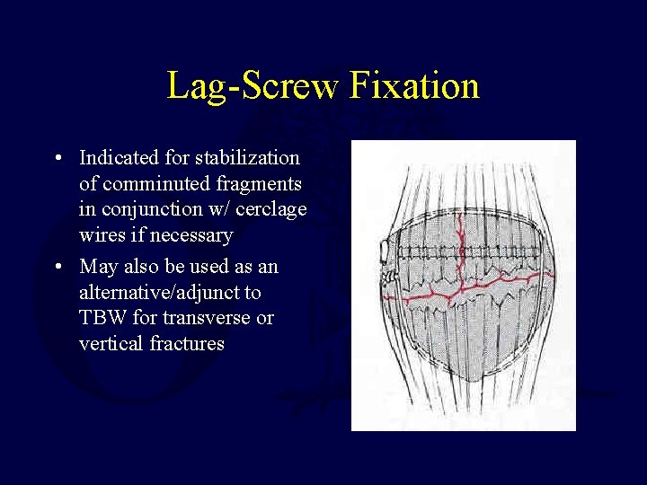 Lag-Screw Fixation • Indicated for stabilization of comminuted fragments in conjunction w/ cerclage wires