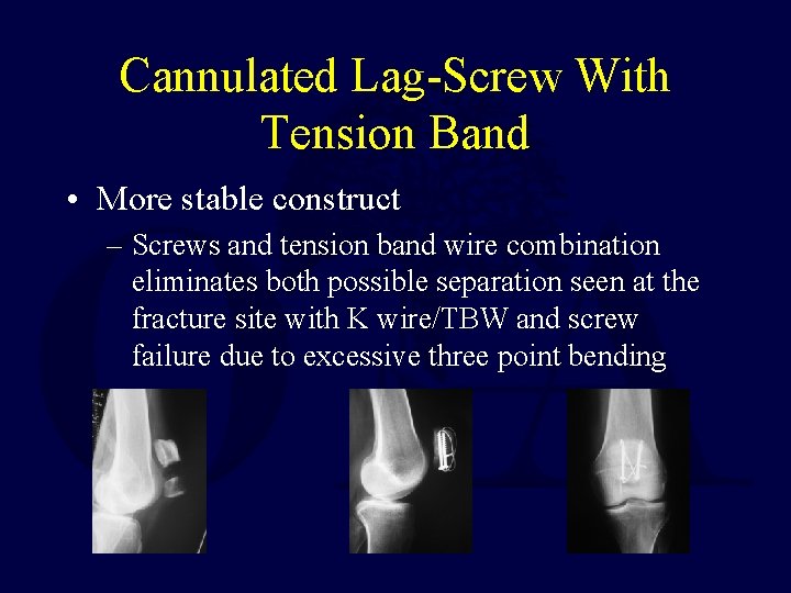 Cannulated Lag-Screw With Tension Band • More stable construct – Screws and tension band