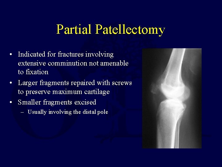 Partial Patellectomy • Indicated for fractures involving extensive comminution not amenable to fixation •