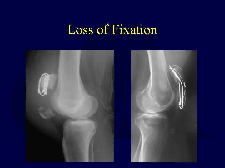 Loss of Fixation 