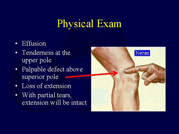 Physical Exam • Effusion • Tenderness at the upper pole • Palpable defect above
