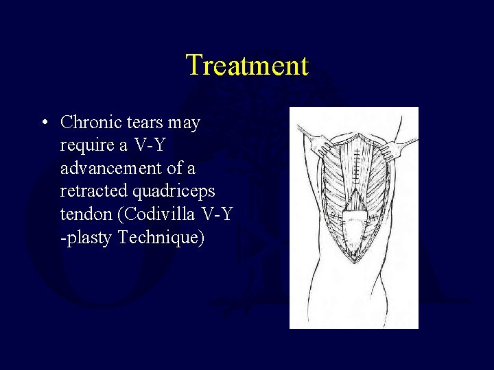 Treatment • Chronic tears may require a V-Y advancement of a retracted quadriceps tendon